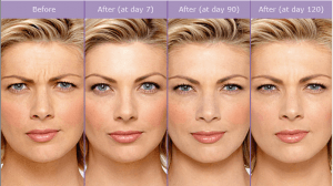 Botox/Dysport before and after