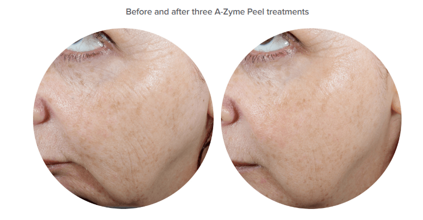 azyme peel vitamin A anto-ageing acne treatment Ultraceuticals